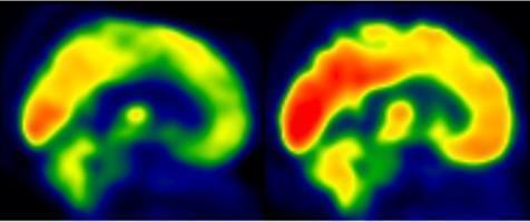 뇌의 글루코스 대사 = 오른쪽이 유산소 운동을 한 피험자의 뇌 사진이다.적색 부위는 글루코스 대사량을 보여준다.[저널 '뇌 유연성' 발췌 / 재판매 및 DB 금지]