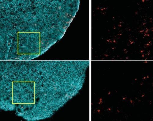 비만과 T세포암세포만 골라 죽이는 CD8+ T세포(적색)는, 비만한 생쥐(하단)보다 비만하지 않은 생쥐(상단)의 종양(청록색)에 훨씬 더 많다.[하버드의대 Ringel 등 제공 / 재판매 및 DB 금지]